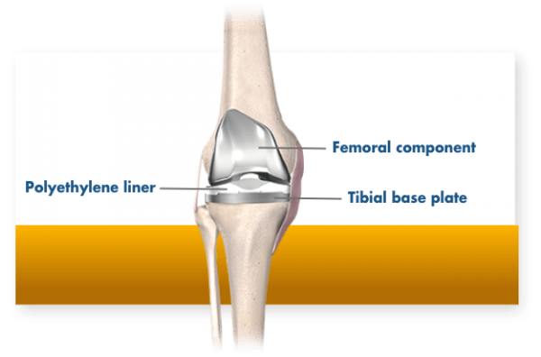 Mako Total Knee Replacement Surgical Hospital Of Oklahoma Llc